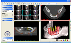 インプラント・シミュレーションシステム