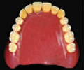 一般的な入れ歯