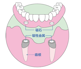 磁性アタッチメントについて1