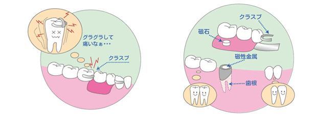 磁性アタッチメントについて2