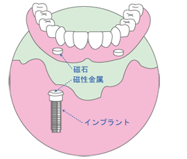 磁性アタッチメントについて5