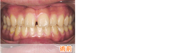 前歯の部分矯正1