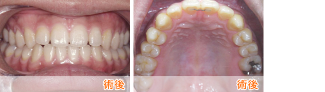 前歯の部分矯正1-2