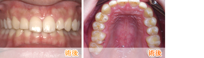 前歯の部分矯正2-2