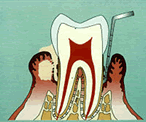 歯周病の進行02