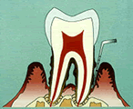 歯周病の進行03